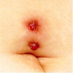 Hypergranulation